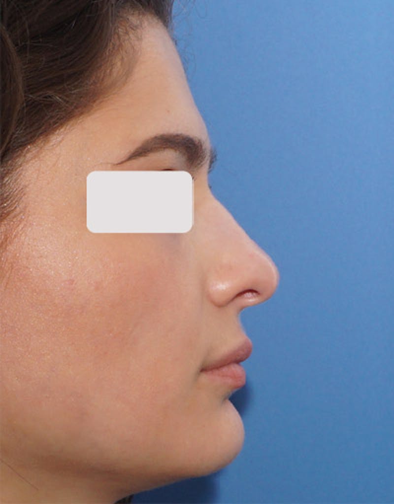 Rhinoplasty Before & After Gallery - Patient 176052 - Image 1