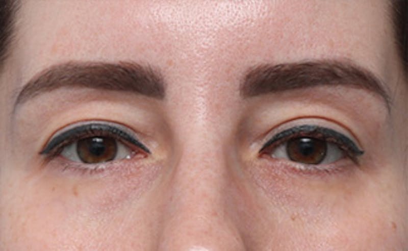 Eyelid Surgery Before & After Gallery - Patient 145522 - Image 7