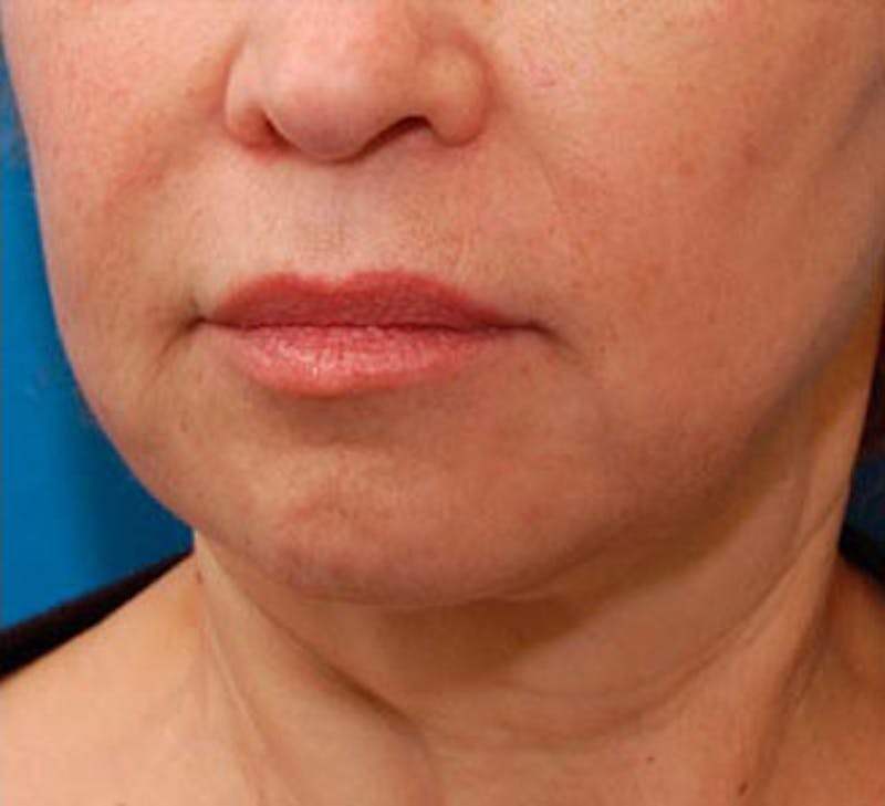 Facelift Before & After Gallery - Patient 107336 - Image 4