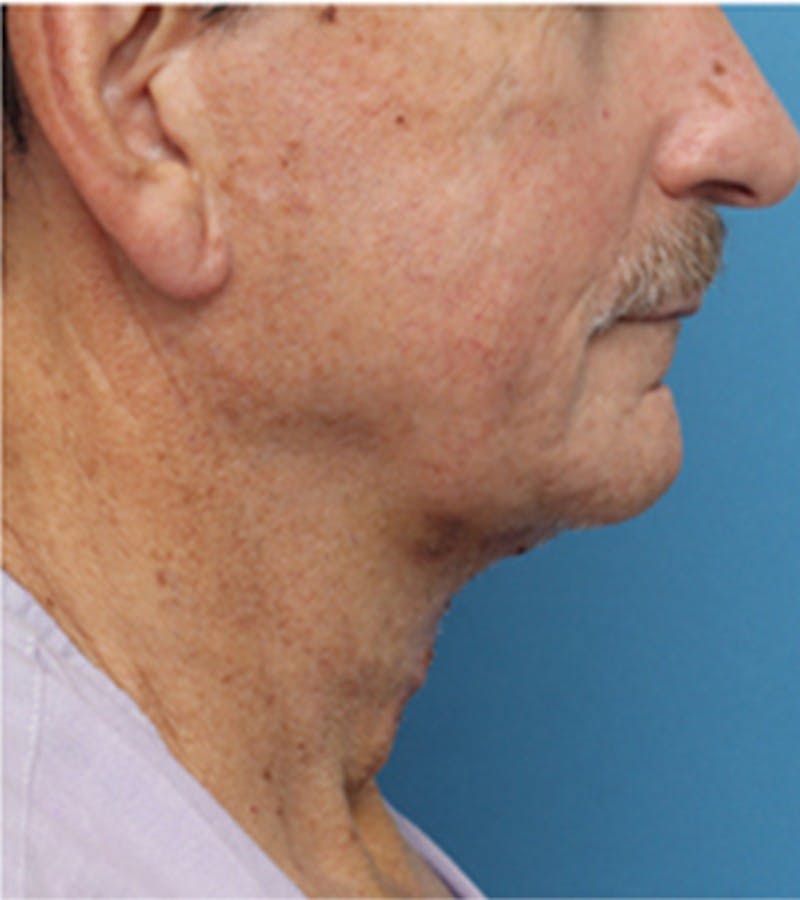 Jawline Contouring Before & After Gallery - Patient 381944 - Image 2