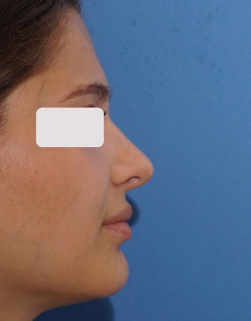 Rhinoplasty Before & After Gallery - Patient 176052 - Image 2