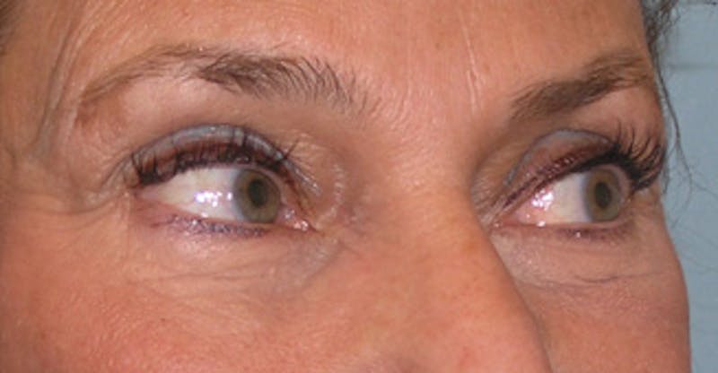Brow Lift Before & After Gallery - Patient 105232 - Image 3