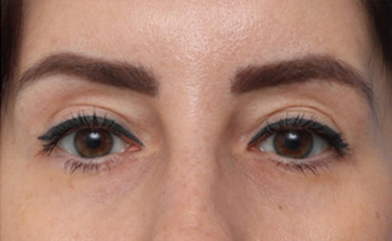 Eyelid Surgery Before & After Gallery - Patient 145522 - Image 8