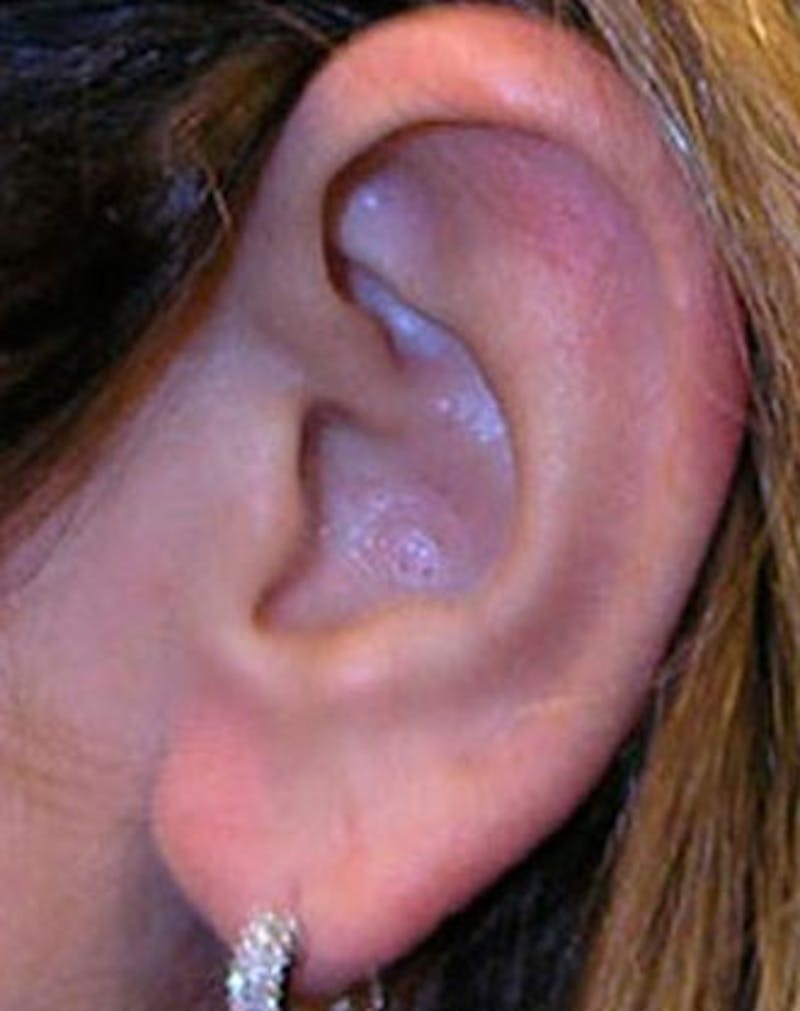 Ear Surgery Before & After Gallery - Patient 237412 - Image 1