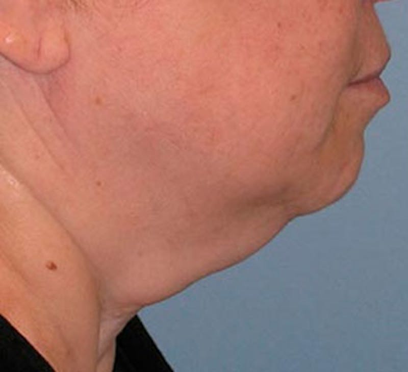 Facelift Before & After Gallery - Patient 107336 - Image 5