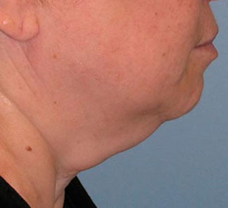 Facelift Before & After Gallery - Patient 107336 - Image 7