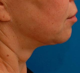 Facelift Before & After Gallery - Patient 107336 - Image 8