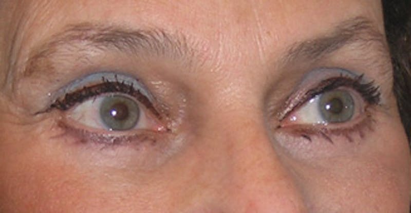 Brow Lift Before & After Gallery - Patient 105232 - Image 4