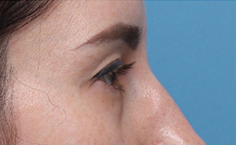 Eyelid Surgery Before & After Gallery - Patient 145522 - Image 3