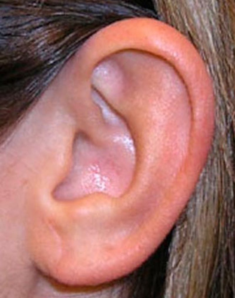 Ear Surgery Before & After Gallery - Patient 237412 - Image 2