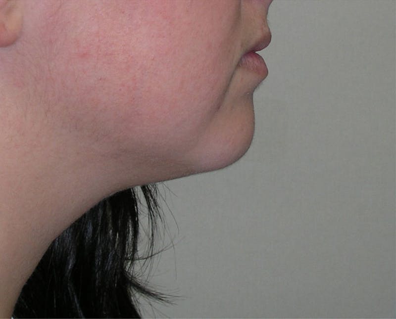 Neck Liposuction Before & After Gallery - Patient 196016 - Image 1