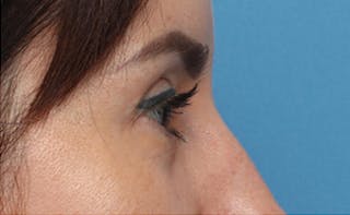 Eyelid Surgery Before & After Gallery - Patient 145522 - Image 4