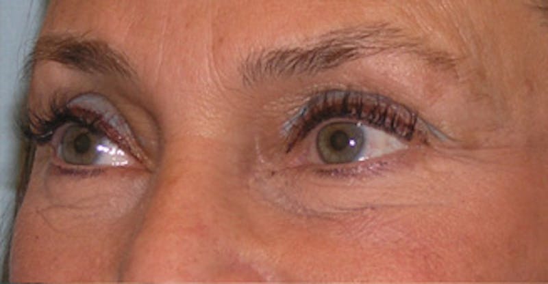 Brow Lift Before & After Gallery - Patient 105232 - Image 5