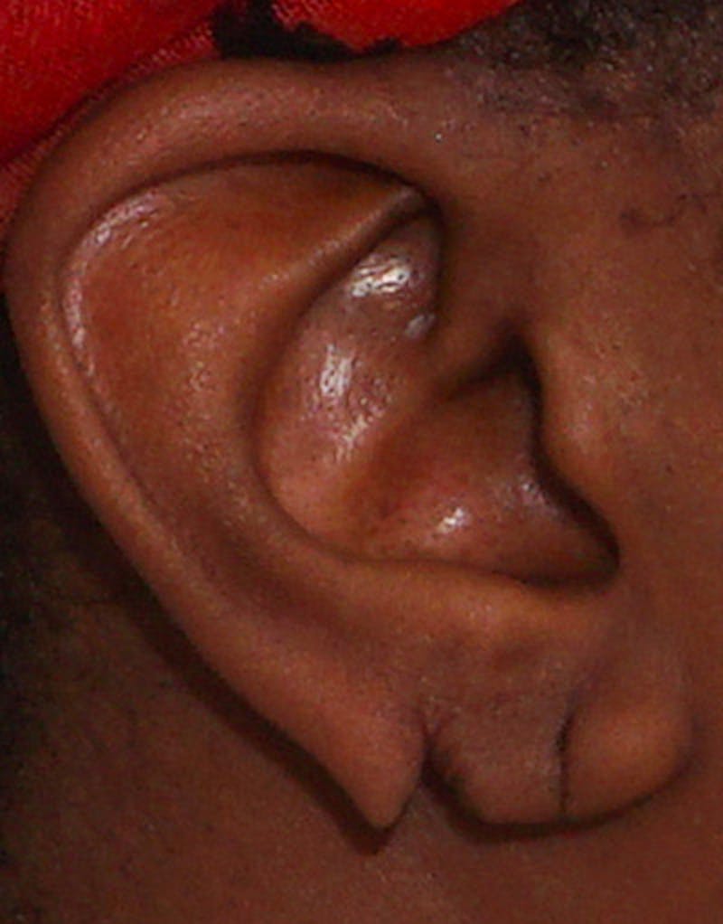 Patient TSMnP6nkTSKRv11kLldyWg - Earlobe Surgery Before & After Photos