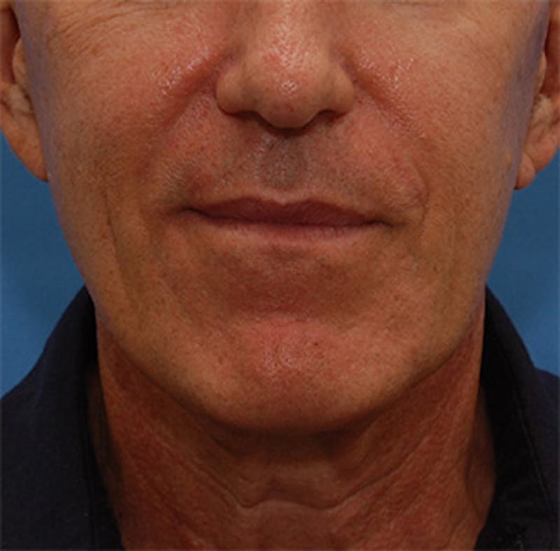 Facelift Before & After Gallery - Patient 136130 - Image 1