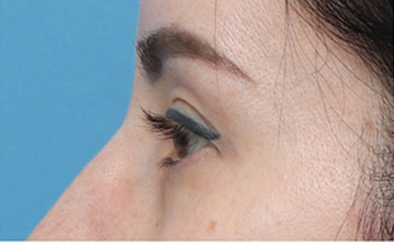 Patient Lxea0wrDT46C2CpCHeRarg - Eyelid Surgery Before & After Photos