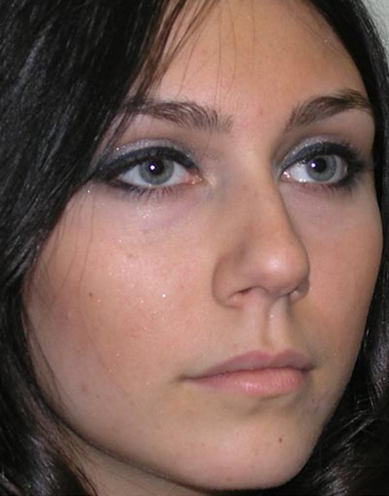 Rhinoplasty Before & After Gallery - Patient 176052 - Image 5