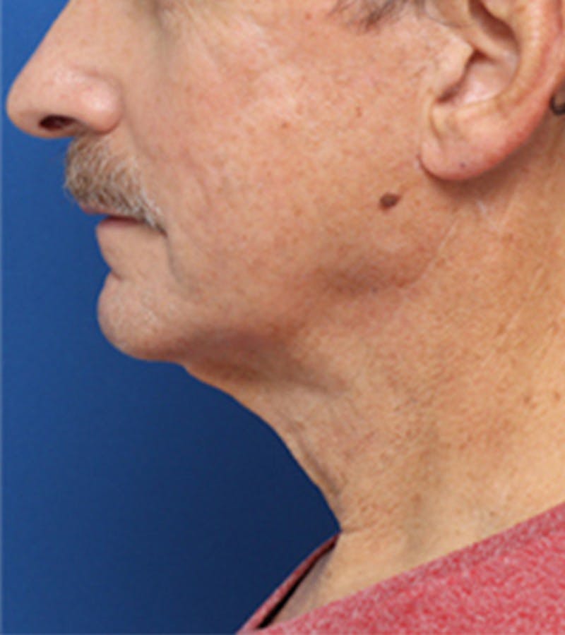 Jawline Contouring Before & After Gallery - Patient 381944 - Image 5
