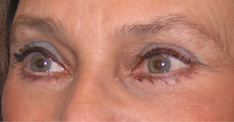 Brow Lift Before & After Gallery - Patient 105232 - Image 6