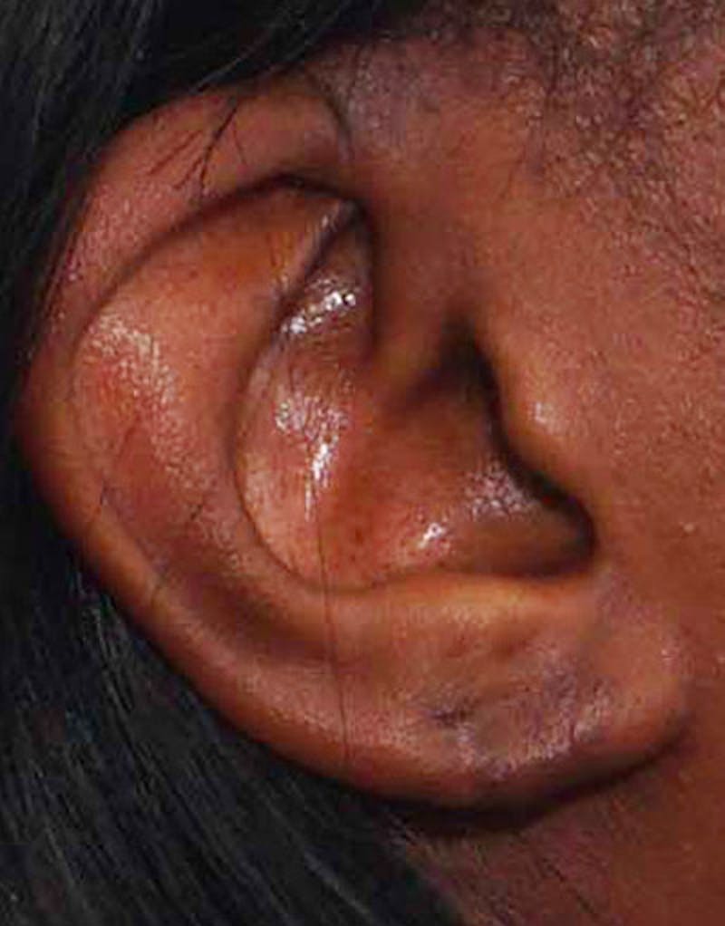 Ear Surgery Before & After Gallery - Patient 276065 - Image 2