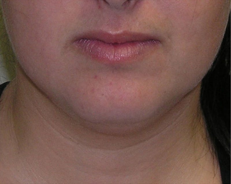 Neck Liposuction Before & After Gallery - Patient 196016 - Image 3