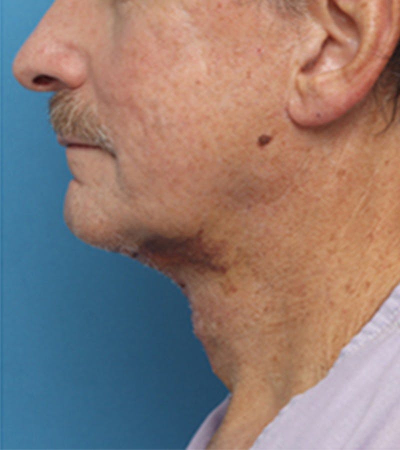 Jawline Contouring Before & After Gallery - Patient 381944 - Image 6