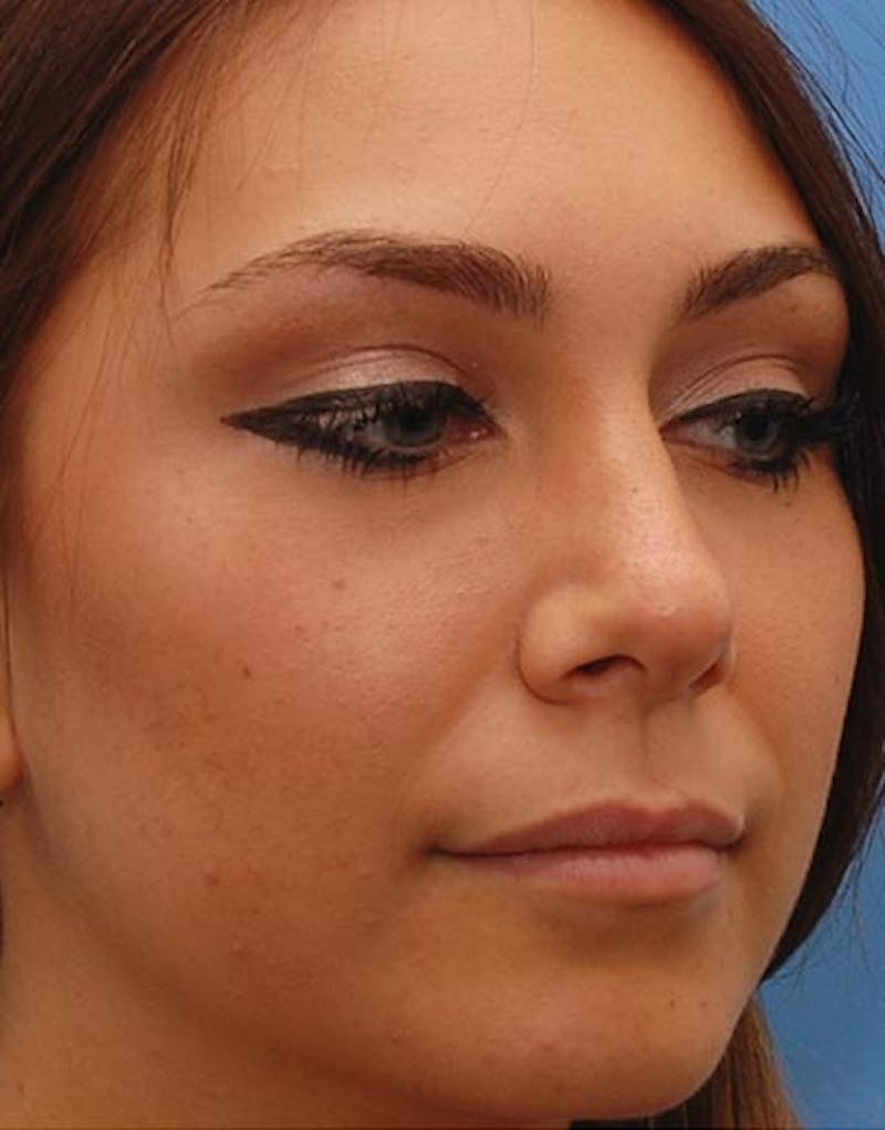 Rhinoplasty Before & After Gallery - Patient 176052 - Image 6