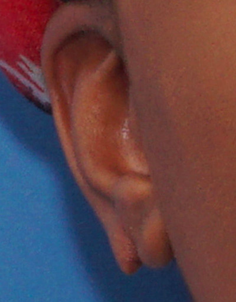 Ear Surgery Before & After Gallery - Patient 276065 - Image 3