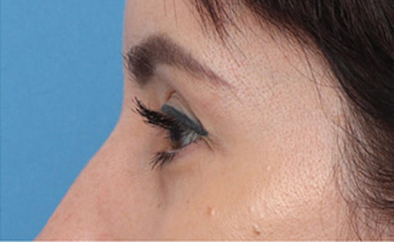 Eyelid Surgery Before & After Gallery - Patient 145522 - Image 6