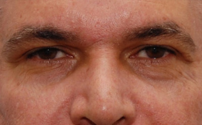Brow Lift Before & After Gallery - Patient 884744 - Image 1