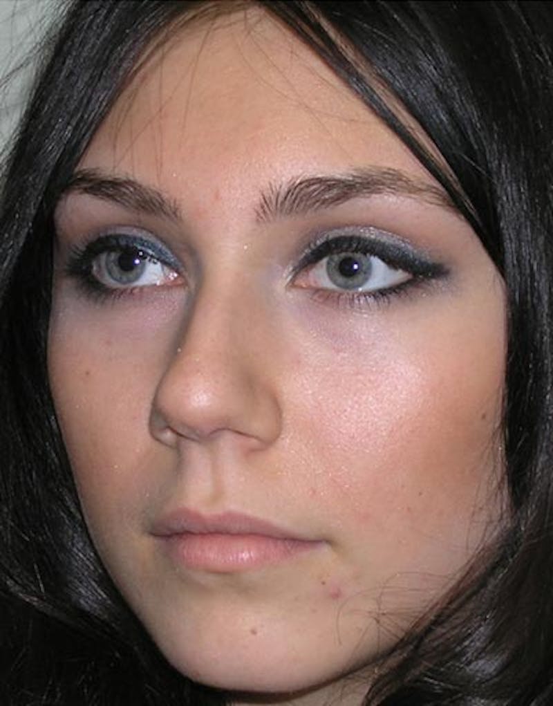 Rhinoplasty Before & After Gallery - Patient 176052 - Image 7