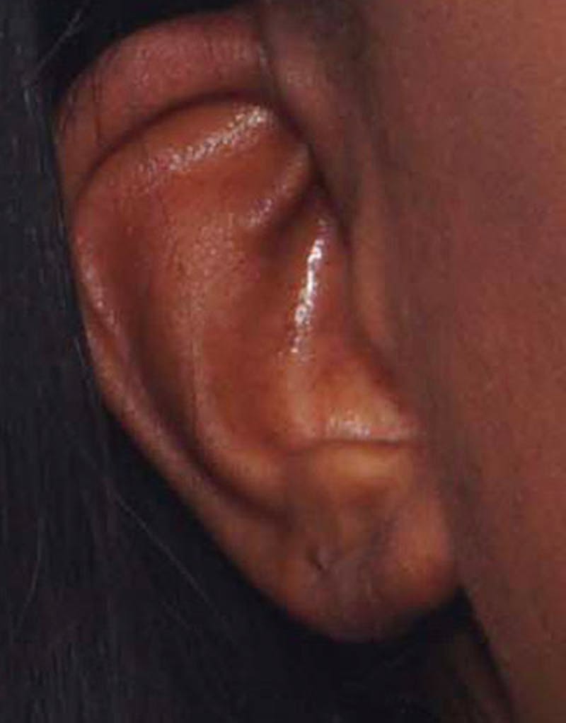 Ear Surgery Before & After Gallery - Patient 276065 - Image 4