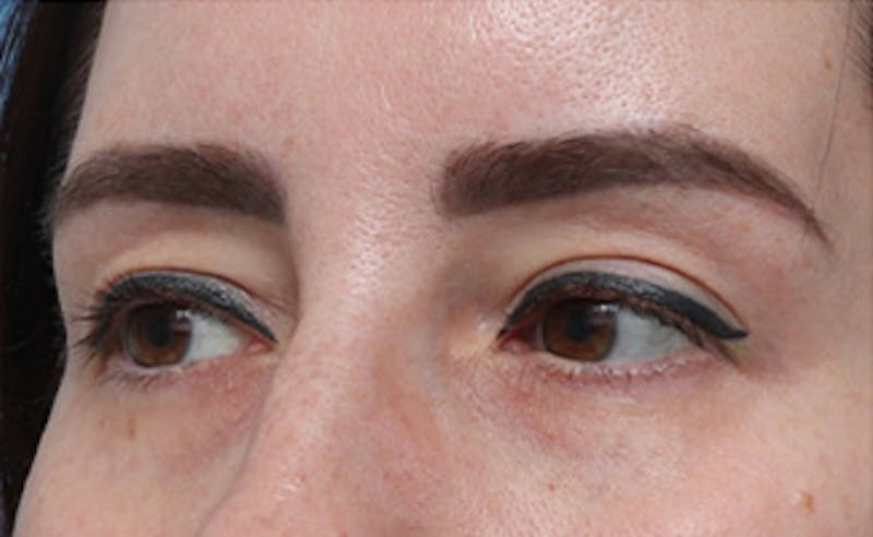 Eyelid Surgery Before & After Gallery - Patient 145522 - Image 7