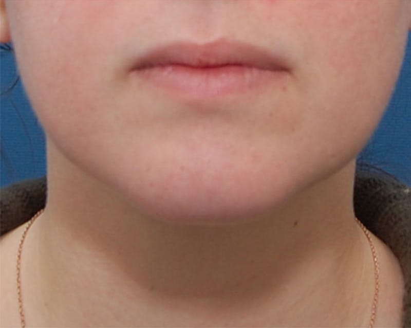 Neck Liposuction Before & After Gallery - Patient 196016 - Image 4