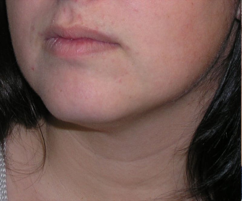 Neck Liposuction Before & After Gallery - Patient 196016 - Image 5