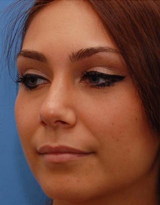 Rhinoplasty Before & After Gallery - Patient 259439 - Image 8