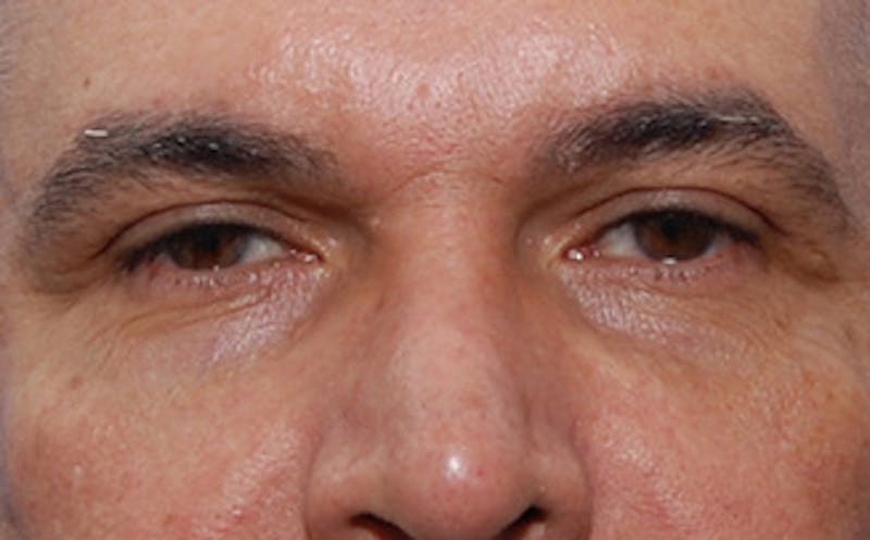Brow Lift Before & After Gallery - Patient 884744 - Image 2