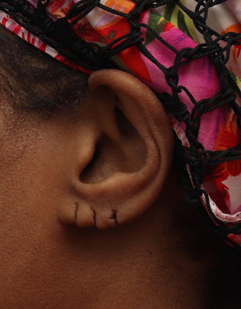 Ear Surgery Before & After Gallery - Patient 107705 - Image 1