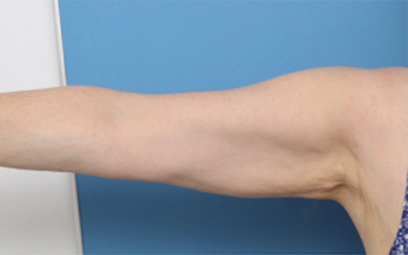 Liposuction (Body) Before & After Gallery - Patient 245990 - Image 2