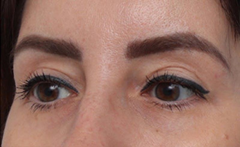 Eyelid Surgery Before & After Gallery - Patient 145522 - Image 6