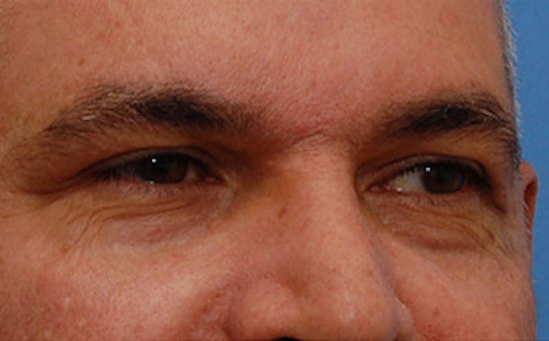 Brow Lift Before & After Gallery - Patient 884744 - Image 3