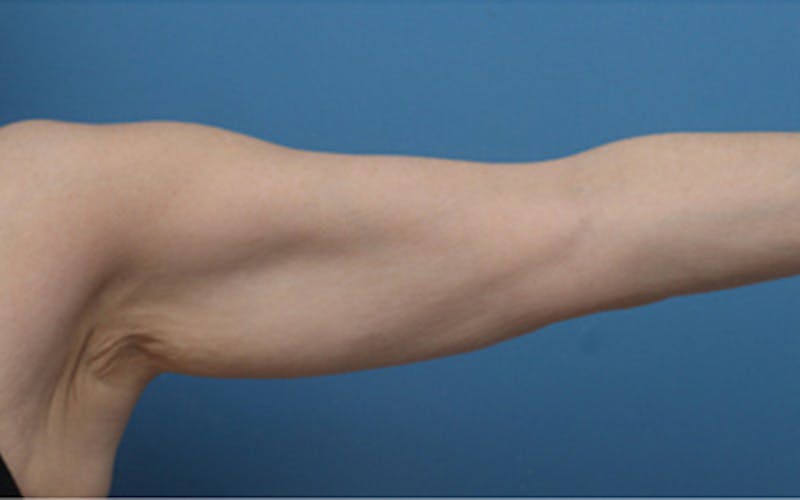 Liposuction (Body) Before & After Gallery - Patient 245990 - Image 3