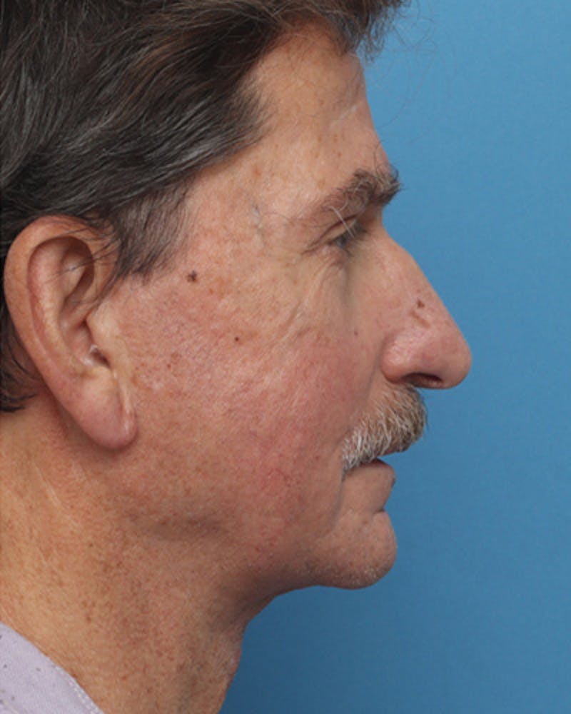 Jawline Contouring Before & After Gallery - Patient 103734 - Image 2