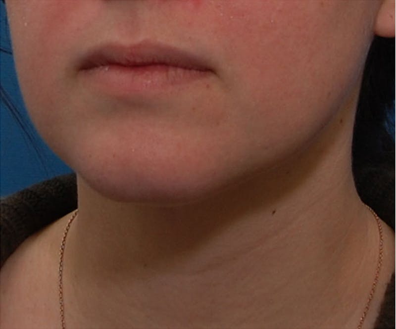 Neck Liposuction Before & After Gallery - Patient 196016 - Image 6