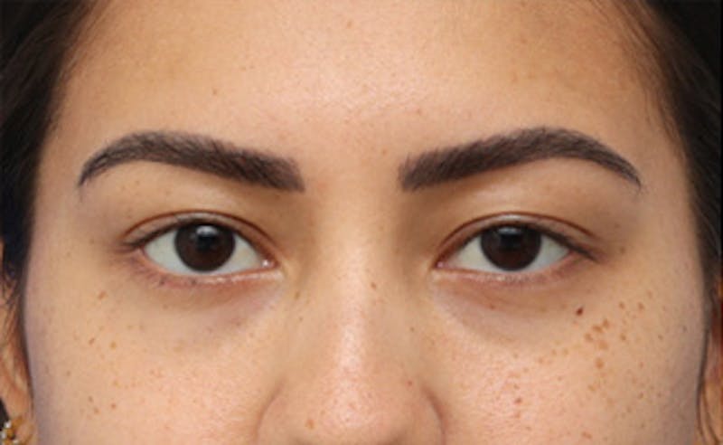 Patient aqmWRniNTPa_1FSXEJ2Mtg - Eyelid Surgery Before & After Photos
