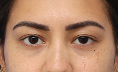 Eyelid Surgery Before & After Gallery - Patient 373989 - Image 1