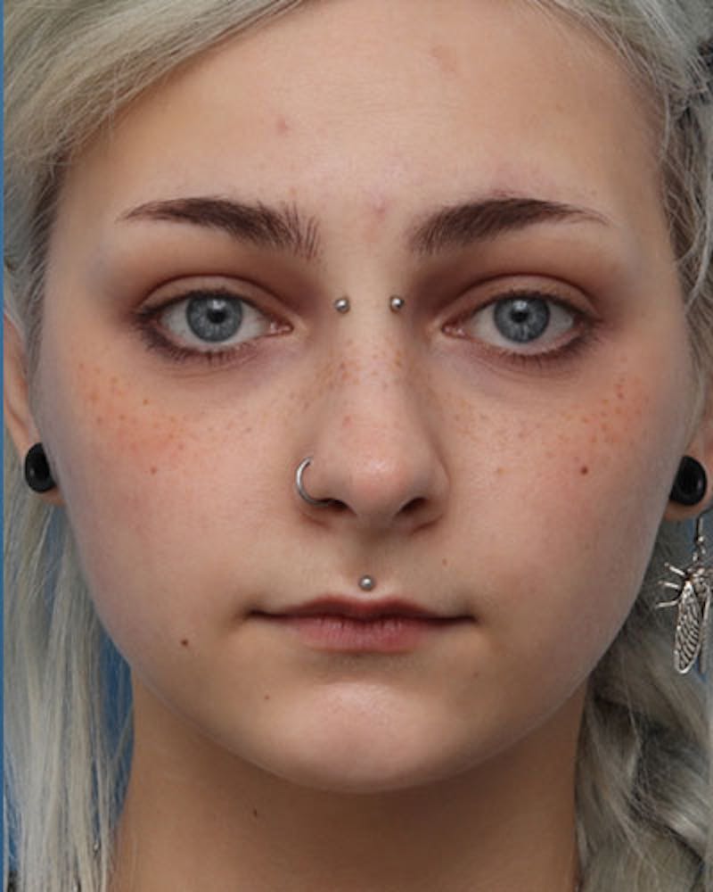 Chin Surgery Before & After Gallery - Patient 842546 - Image 1