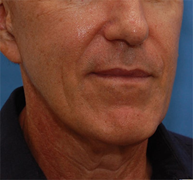 Facelift Before & After Gallery - Patient 136130 - Image 5