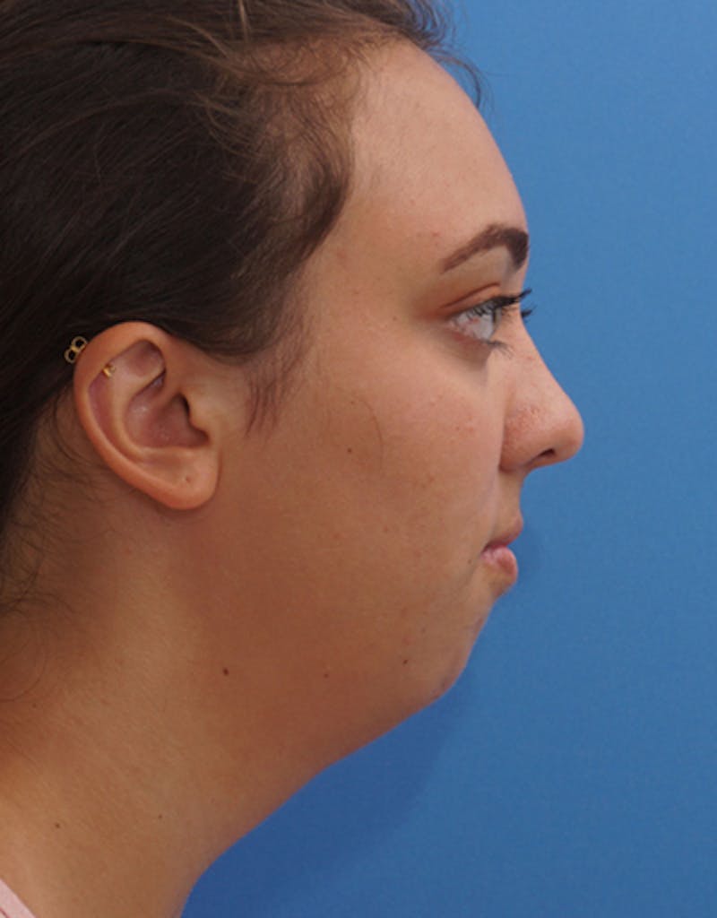 Neck Liposuction Before & After Gallery - Patient 398358 - Image 1