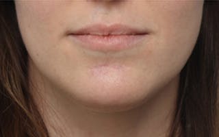 Scar Revision Before & After Gallery - Patient 269025 - Image 2